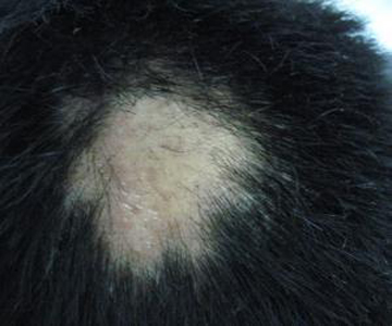 毛发疾病——斑秃