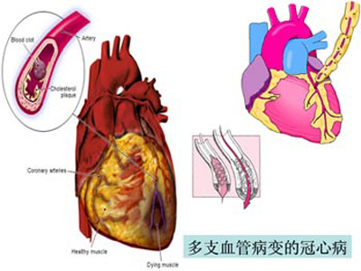 常见病冠心病