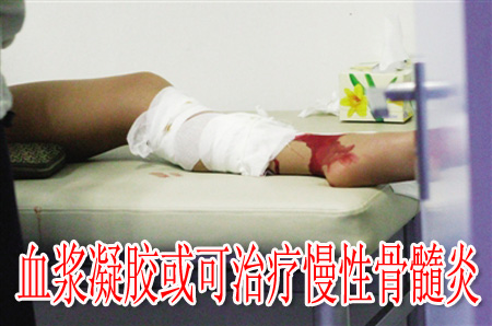 血浆凝胶或可治疗慢性骨髓炎