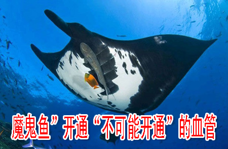 魔鬼鱼”开通“不可能开通”的血管