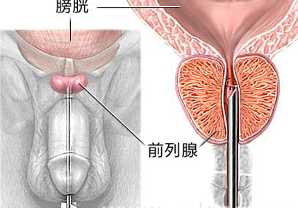 前列腺疾病