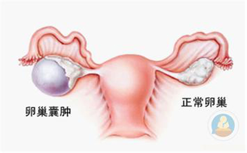 卵巢囊肿，抱腿压涌泉穴，给你爱心呵护