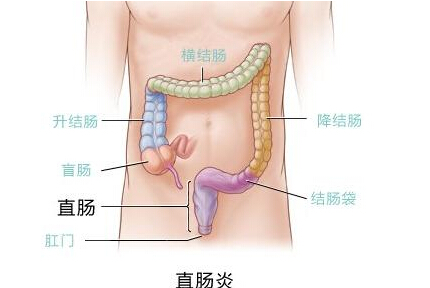 疡溃疡性结肠炎的拔罐疗法