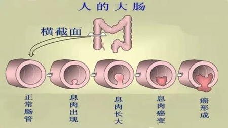 大肠癌发病率升高 肠息肉是一颗“定时炸弹”