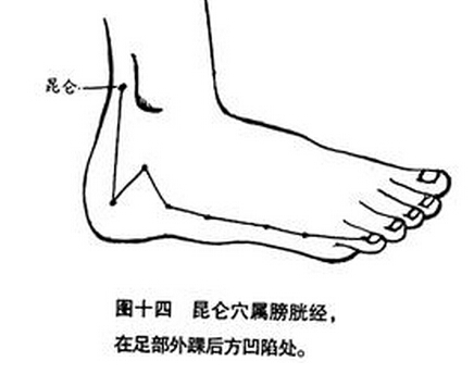 中医针刺昆仑穴可以治疗落枕