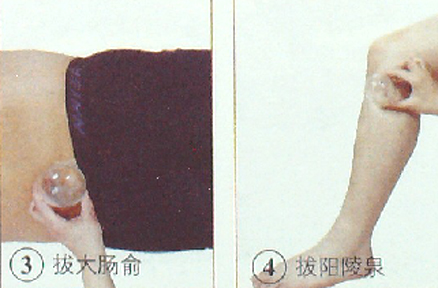 乳腺增生的抜罐疗法