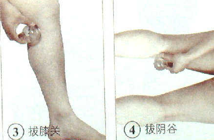 膝关节痛的拔罐疗法