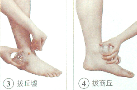 踝关节扭伤的拔罐疗法