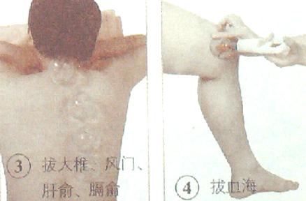 银屑病的拔罐疗法