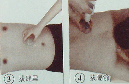 小儿厌食症的拔罐疗法