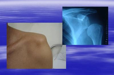肩关节是临床中最常见的受损伤关节部位之一