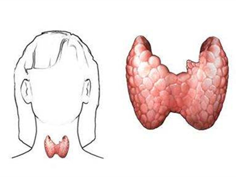 治疗地方性甲状脓肿